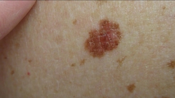Close-up clinical image of a pigmented melanoma lesion with irregular dark brown borders on pale skin